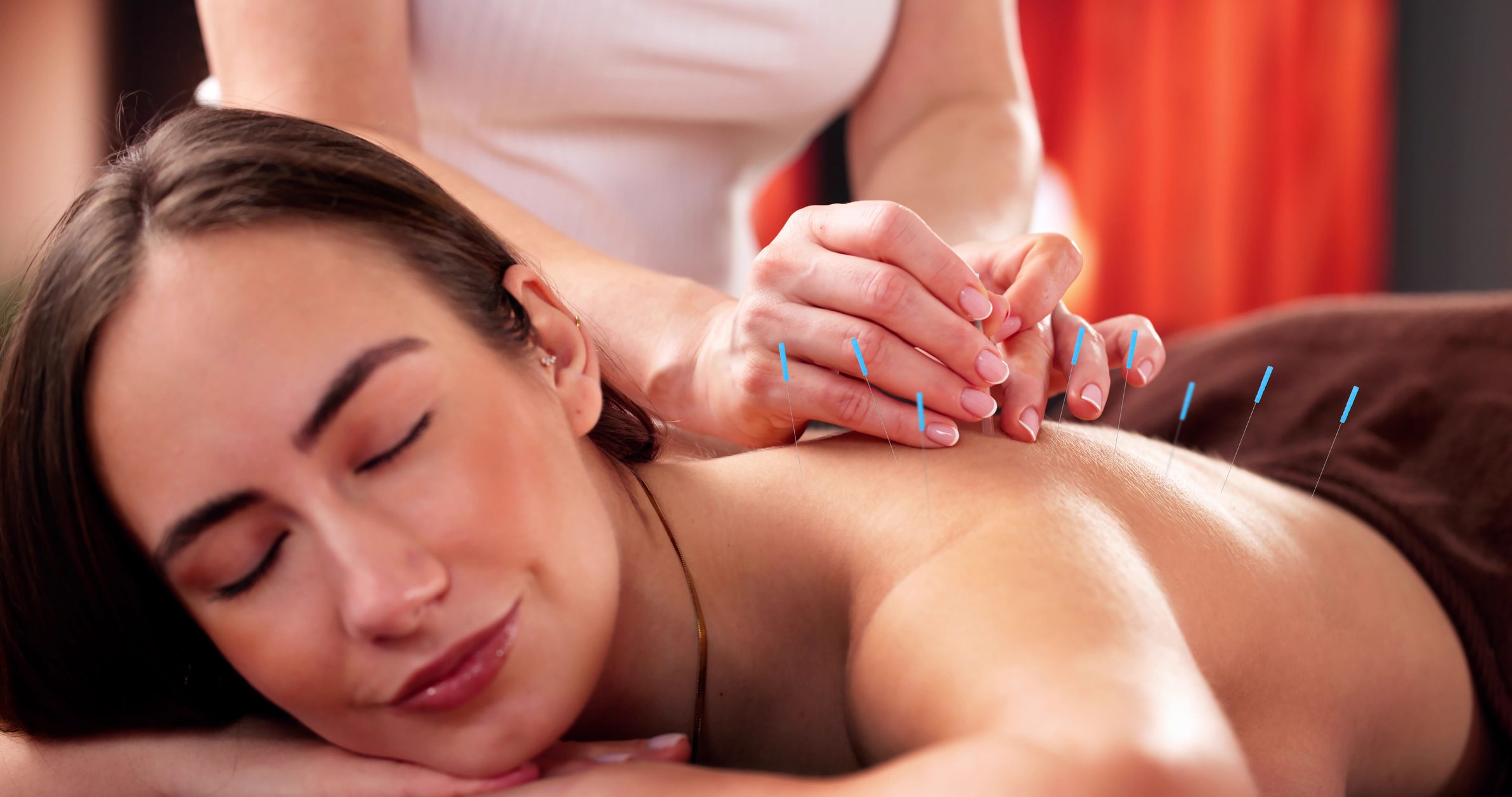 Acupuncture therapy on woman's back