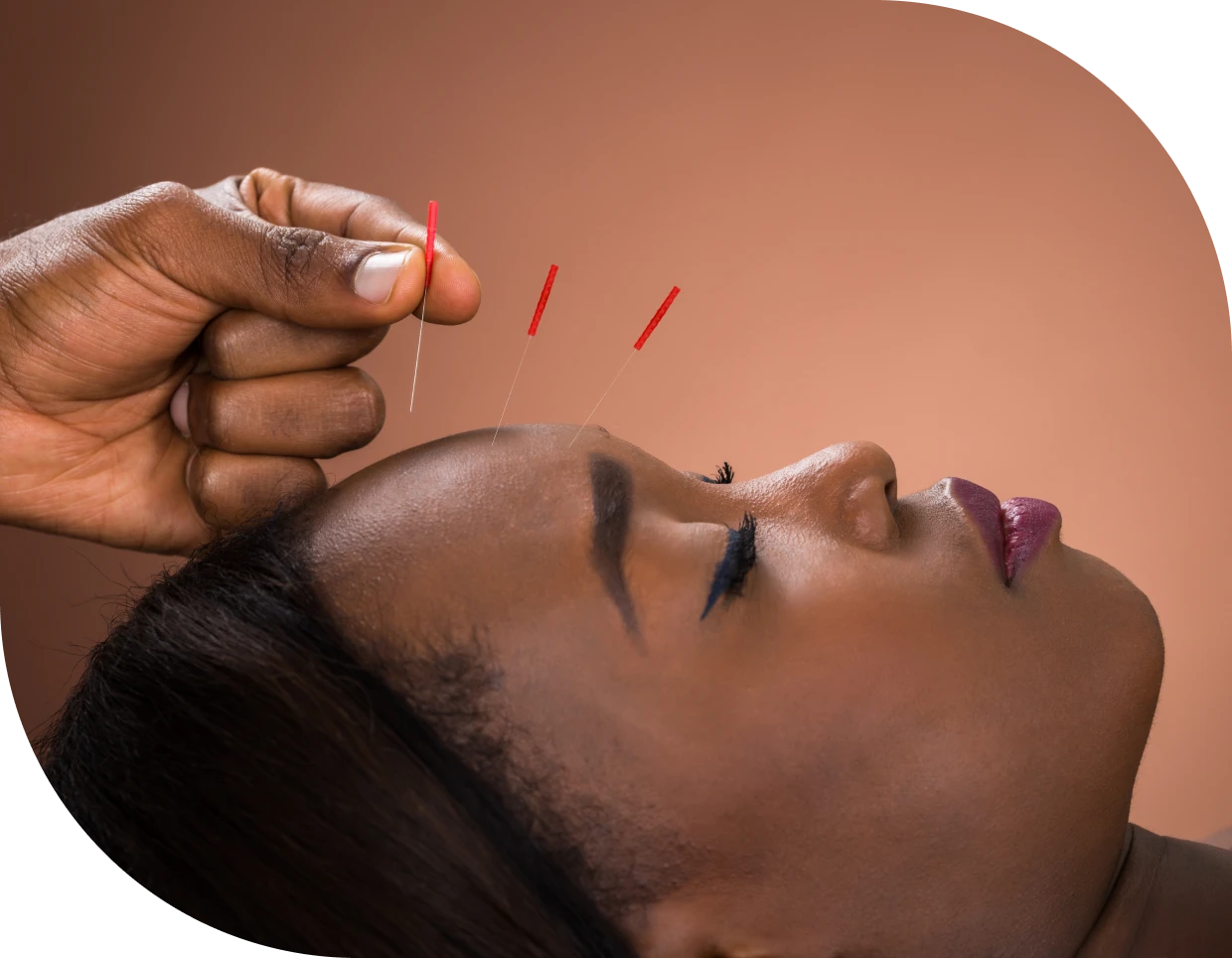 Acupuncture needle on forehead