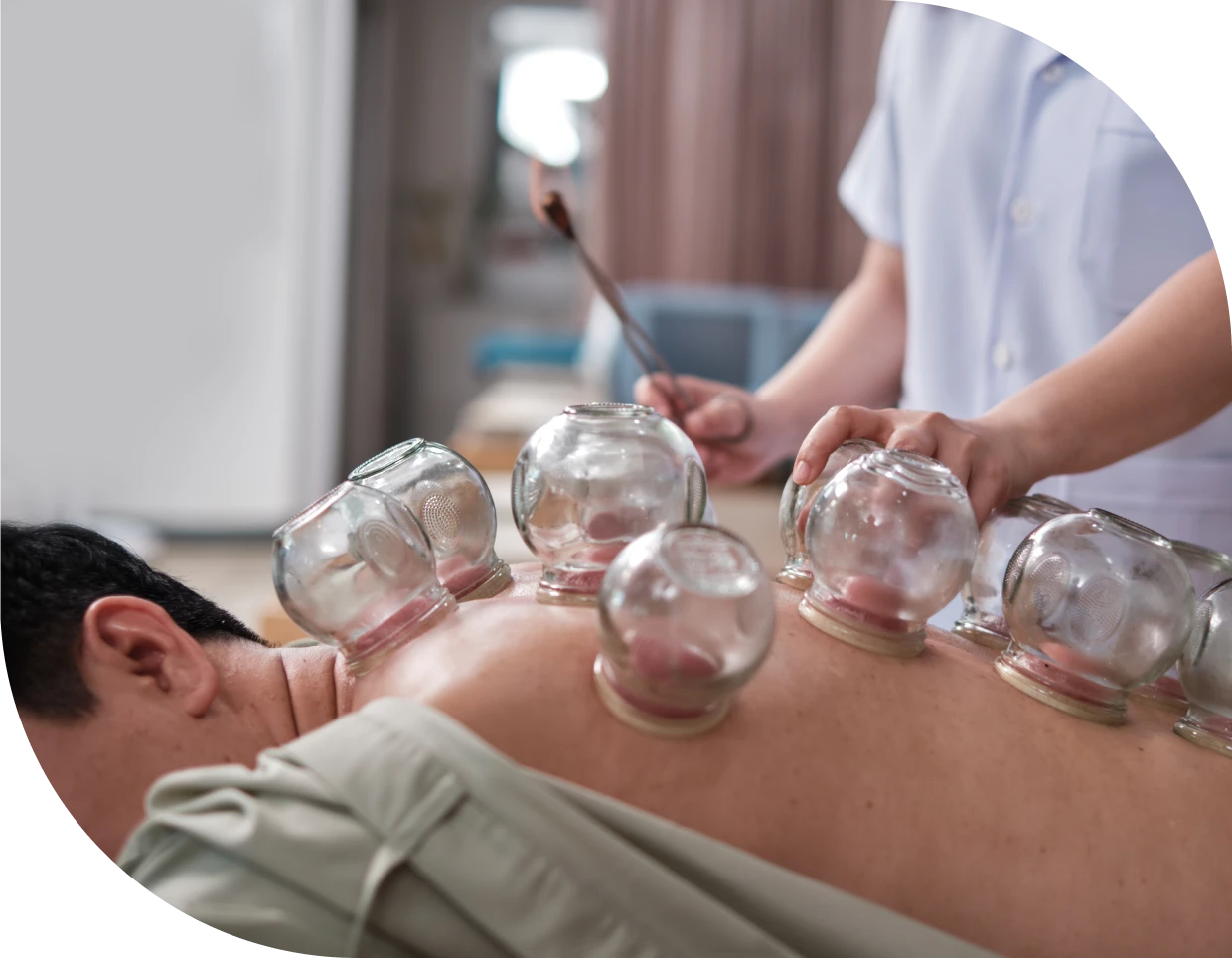 Cupping therapy on person's back